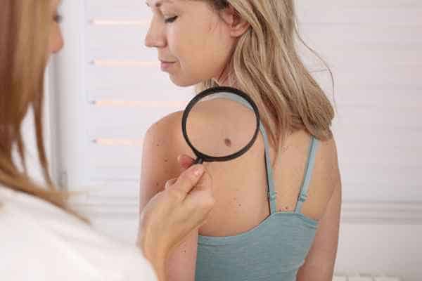 What Are Traditional Skin Lesion Removal Methods Uxbridge?