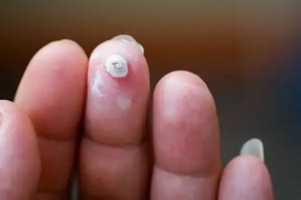Image of white wart before cryopen treatment Uxbridge