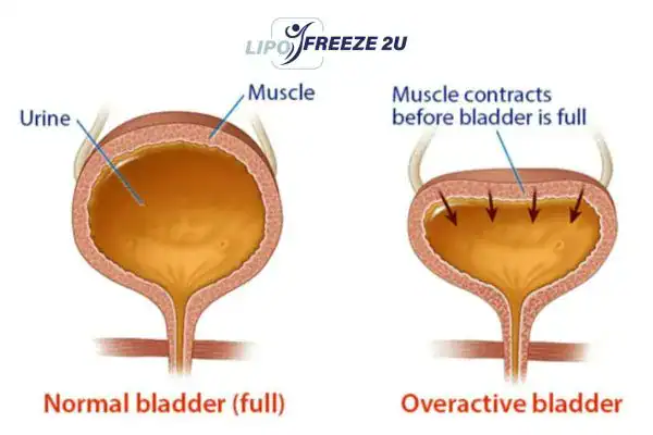 diagram of overactive bladder treatment Uxbridge