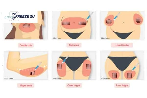 Benefits of Choosing Aqualyx for Fat Reduction Uxbridge