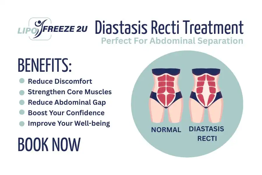 How Long Will It Take to See Improvements in Diastasis Recti Uxbridge