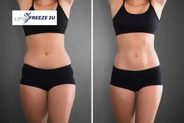 How Can LIPO FREEZE 2U Support Your Post-Pregnancy Body Recovery Uxbridge?