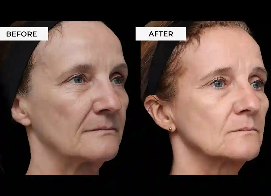 How Many RF Microneedling Sessions Will You Need to See a Difference Uxbridge?