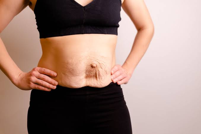 Is Surgery Really the Only Way to Repair Diastasis Recti Uxbridge?