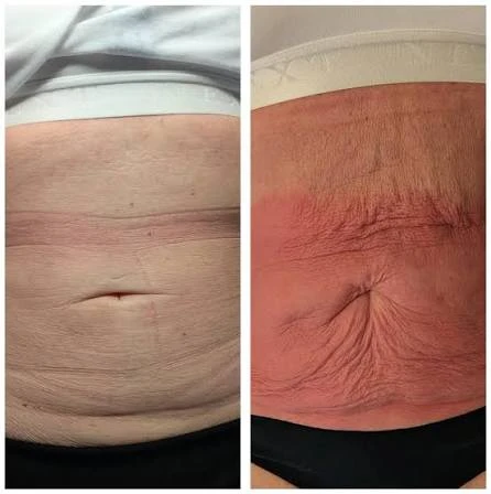 How Does RF Microneedling Improve Crepey, Thin and Uneven Skin Texture Uxbridge?