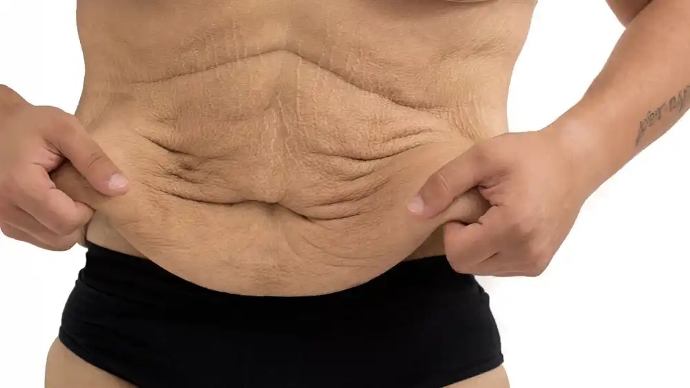 Why Does Weight Loss Medication Leave Some People With Loose or Sagging Skin Uxbridge?